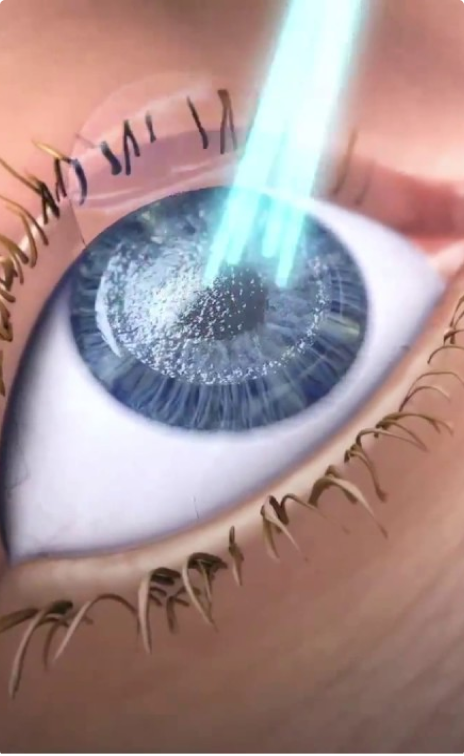 Cirurgia refrativa a laser: visão perfeita sem óculos com uma das tecnologias mais modernas do mundo