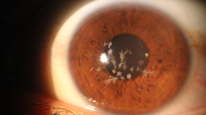 Imagem sobre o Exame de Ultrassonografia Ocular