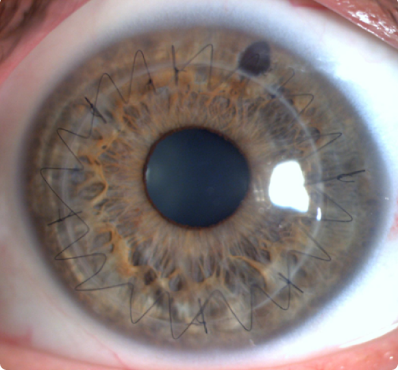 Imagem sobre o Exame de Ultrassonografia Ocular